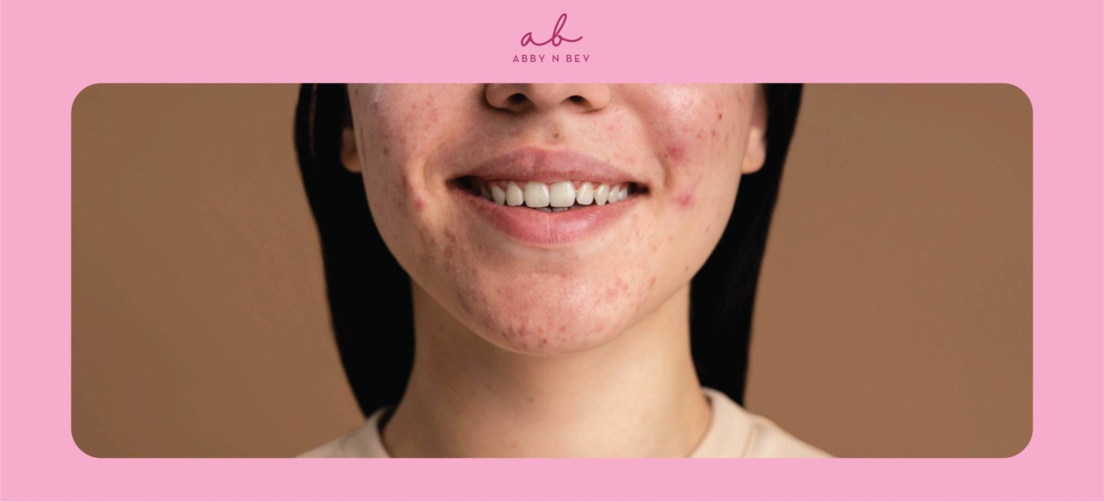 Stop Panik! Ini Cara Mengatasi Jerawat Meradang dengan Cepat dan Aman Tanpa Bekas