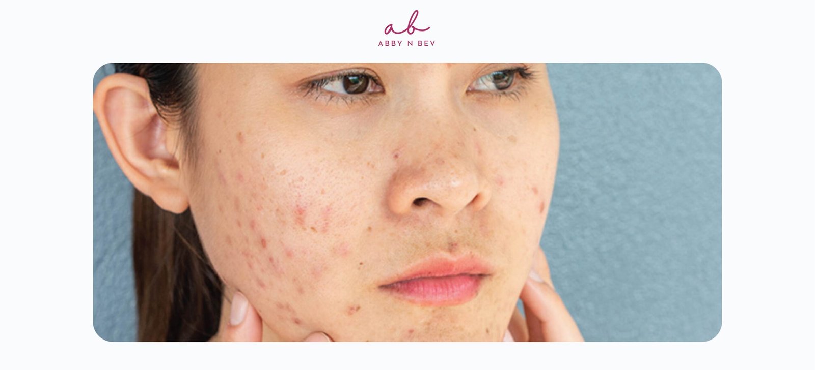 Skincare untuk Kulit Breakout Pakai Apa Sih? Ini Rekomendasinya!