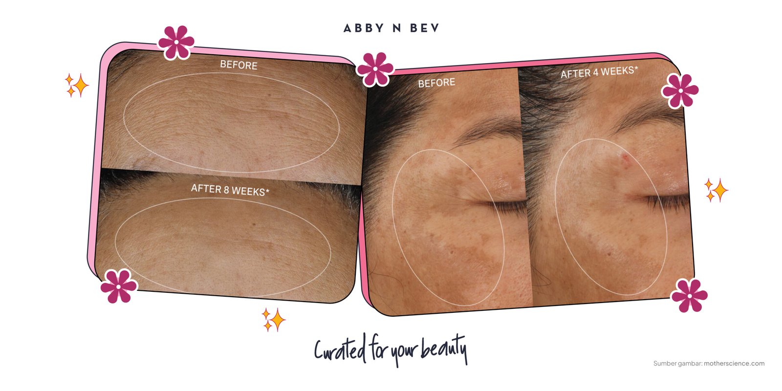 Apa Itu Malassezin? Benarkah Bisa Mencerahkan Kulit, Ini Faktanya!