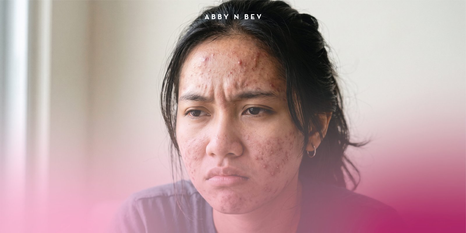 Skincare Terbaik Kulit Berjerawat dari Brand Lokal Favorit